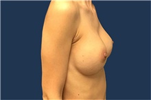 Breast Augmentation After Photo by Tommaso Addona, MD; Garden City, NY - Case 41039