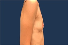 Breast Augmentation Before Photo by Tommaso Addona, MD; Garden City, NY - Case 41039