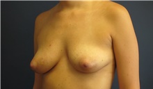Breast Reconstruction Before Photo by Tommaso Addona, MD; Garden City, NY - Case 41043