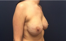 Breast Reconstruction After Photo by Tommaso Addona, MD; Garden City, NY - Case 41043