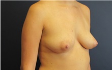 Breast Reconstruction Before Photo by Tommaso Addona, MD; Garden City, NY - Case 41043