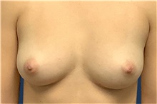 Breast Augmentation Before Photo by Tommaso Addona, MD; Garden City, NY - Case 41045