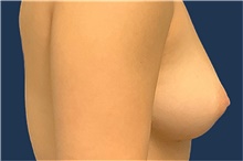 Breast Augmentation Before Photo by Tommaso Addona, MD; Garden City, NY - Case 41045