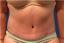 Tummy Tuck After Photo by Tommaso Addona, MD; Garden City, NY - Case 41048