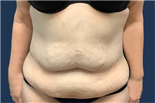 Tummy Tuck Before Photo by Tommaso Addona, MD; Garden City, NY - Case 41048