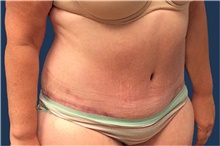 Tummy Tuck After Photo by Tommaso Addona, MD; Garden City, NY - Case 41048