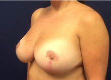 Breast Reduction After Photo by Tommaso Addona, MD; Garden City, NY - Case 41417