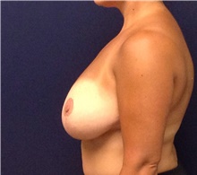 Breast Reduction Before Photo by Tommaso Addona, MD; Garden City, NY - Case 41417