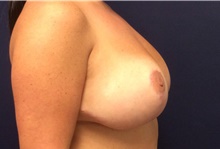 Breast Reduction After Photo by Tommaso Addona, MD; Garden City, NY - Case 41417