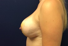 Breast Reduction After Photo by Tommaso Addona, MD; Garden City, NY - Case 41418