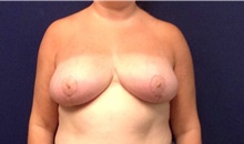 Breast Reduction After Photo by Tommaso Addona, MD; Garden City, NY - Case 41758