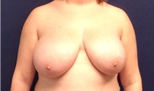 Breast Reduction Before Photo by Tommaso Addona, MD; Garden City, NY - Case 41758