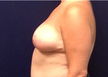 Breast Reduction After Photo by Tommaso Addona, MD; Garden City, NY - Case 41758