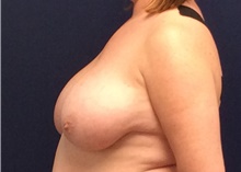 Breast Reduction Before Photo by Tommaso Addona, MD; Garden City, NY - Case 41758