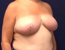 Breast Reduction After Photo by Tommaso Addona, MD; Garden City, NY - Case 41758