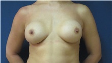 Breast Augmentation Before Photo by Tommaso Addona, MD; Garden City, NY - Case 42516