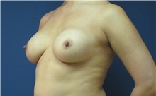 Breast Augmentation Before Photo by Tommaso Addona, MD; Garden City, NY - Case 42516