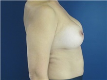 Breast Augmentation After Photo by Tommaso Addona, MD; Garden City, NY - Case 42516
