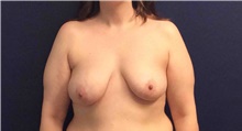 Breast Reconstruction Before Photo by Tommaso Addona, MD; Garden City, NY - Case 42517