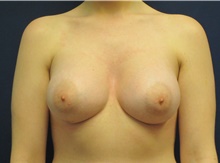 Breast Augmentation After Photo by Tommaso Addona, MD; Garden City, NY - Case 42518