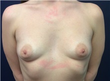 Breast Augmentation Before Photo by Tommaso Addona, MD; Garden City, NY - Case 42518