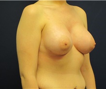 Breast Augmentation After Photo by Tommaso Addona, MD; Garden City, NY - Case 42518