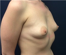 Breast Augmentation Before Photo by Tommaso Addona, MD; Garden City, NY - Case 42518