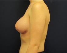 Breast Augmentation After Photo by Tommaso Addona, MD; Garden City, NY - Case 42518