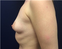 Breast Augmentation Before Photo by Tommaso Addona, MD; Garden City, NY - Case 42518