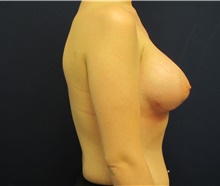 Breast Augmentation After Photo by Tommaso Addona, MD; Garden City, NY - Case 42518