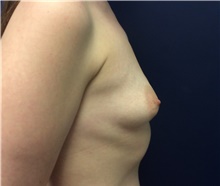 Breast Augmentation Before Photo by Tommaso Addona, MD; Garden City, NY - Case 42518