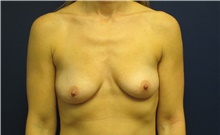 Breast Augmentation Before Photo by Tommaso Addona, MD; Garden City, NY - Case 42519