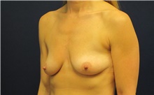 Breast Augmentation Before Photo by Tommaso Addona, MD; Garden City, NY - Case 42519