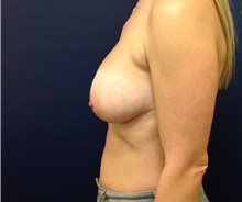 Breast Augmentation After Photo by Tommaso Addona, MD; Garden City, NY - Case 42519