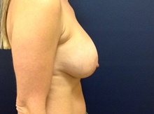 Breast Augmentation After Photo by Tommaso Addona, MD; Garden City, NY - Case 42519