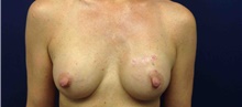 Breast Reconstruction After Photo by Tommaso Addona, MD; Garden City, NY - Case 44821