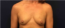 Breast Reconstruction Before Photo by Tommaso Addona, MD; Garden City, NY - Case 44821