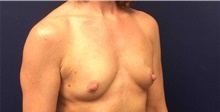 Breast Reconstruction Before Photo by Tommaso Addona, MD; Garden City, NY - Case 44821