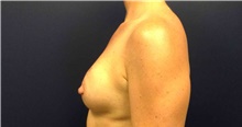 Breast Reconstruction After Photo by Tommaso Addona, MD; Garden City, NY - Case 44821