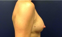 Breast Reconstruction After Photo by Tommaso Addona, MD; Garden City, NY - Case 44821
