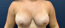 Breast Augmentation After Photo by Tommaso Addona, MD; Garden City, NY - Case 44822