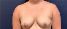 Breast Augmentation Before Photo by Tommaso Addona, MD; Garden City, NY - Case 44822