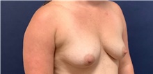 Breast Augmentation Before Photo by Tommaso Addona, MD; Garden City, NY - Case 44822