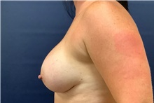 Breast Augmentation After Photo by Tommaso Addona, MD; Garden City, NY - Case 44822