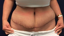 Breast Reduction After Photo by Tommaso Addona, MD; Garden City, NY - Case 44823