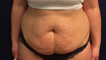 Breast Reduction Before Photo by Tommaso Addona, MD; Garden City, NY - Case 44823