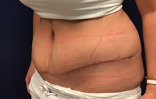 Breast Reduction After Photo by Tommaso Addona, MD; Garden City, NY - Case 44823