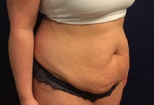 Breast Reduction Before Photo by Tommaso Addona, MD; Garden City, NY - Case 44823