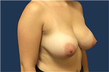 Breast Reduction Before Photo by Tommaso Addona, MD; Garden City, NY - Case 44858