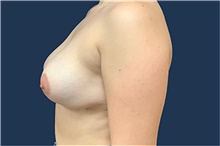 Breast Reduction After Photo by Tommaso Addona, MD; Garden City, NY - Case 44858